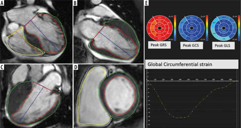 Feature-tracking cardiac magnetic resonance method: a valuable marker of replacement fibrosis in hypertrophic cardiomyopathy.