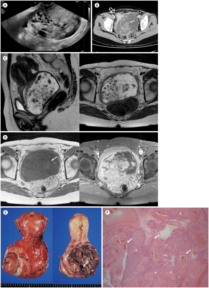 A Rare Angioleiomyoma of the Uterine Cervix: A Case Report with Peculiar MRI Findings.