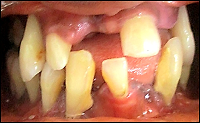 Prevalence and risk indicators for severe periodontitis in Côte d'Ivoire.