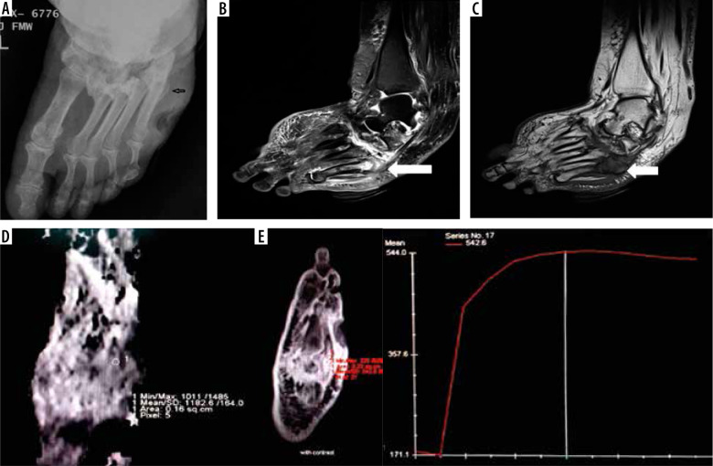 The role of diffusion-weighted imaging and dynamic contrast-enhanced magnetic resonance imaging for the diagnosis of diabetic foot osteomyelitis: a preliminary report.