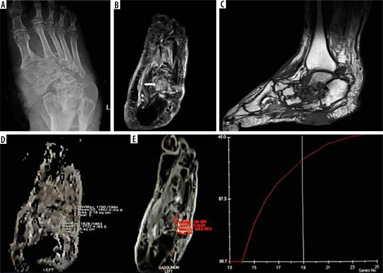 The role of diffusion-weighted imaging and dynamic contrast-enhanced magnetic resonance imaging for the diagnosis of diabetic foot osteomyelitis: a preliminary report.