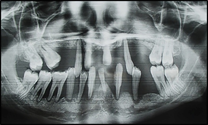 Prevalence and risk indicators for severe periodontitis in Côte d'Ivoire.