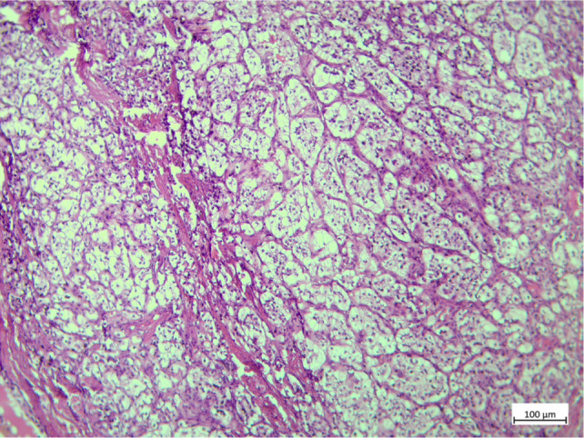 Simultaneous Bilateral Testicular Metastases from Renal Clear Cell Carcinoma: A Rare Presentation in Von Hippel-Lindau disease.