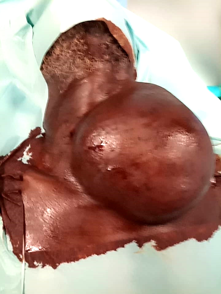 [Giant cervical lipoma: Report on one case in Ouagadougou, Burkina Faso].