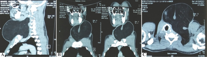 [Giant cervical lipoma: Report on one case in Ouagadougou, Burkina Faso].