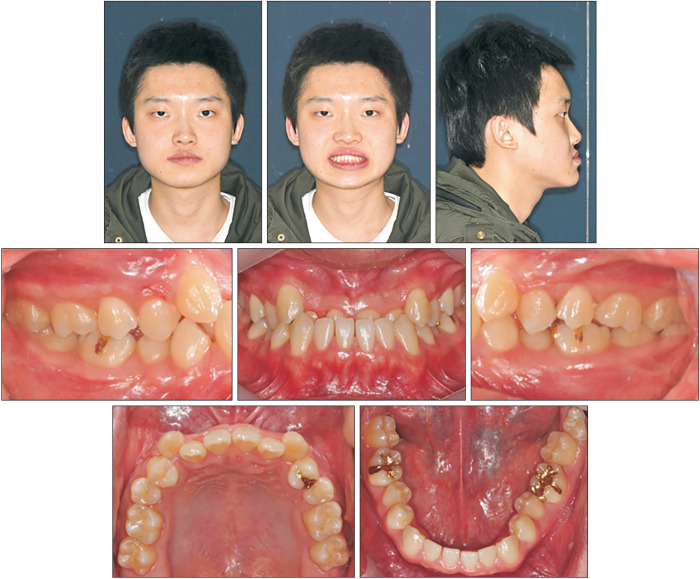 Camouflage treatment by backward rotation of the mandible for a severe skeletal Class III malocclusion with aplastic anemia: A case report.