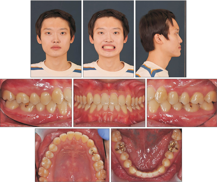 Camouflage treatment by backward rotation of the mandible for a severe skeletal Class III malocclusion with aplastic anemia: A case report.