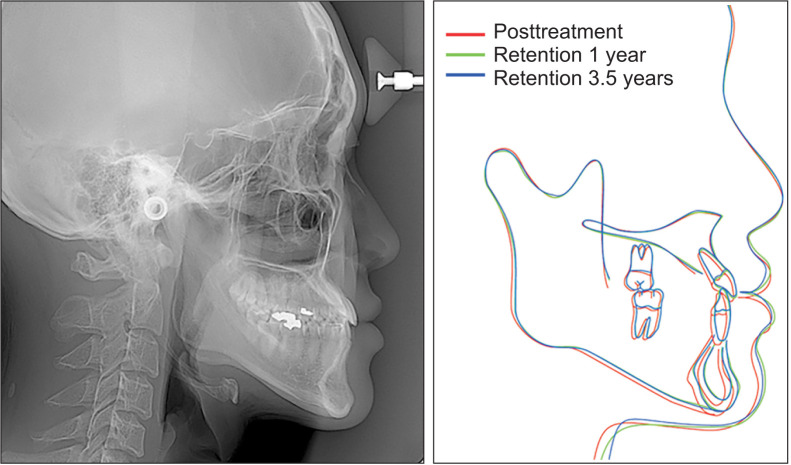 Camouflage treatment by backward rotation of the mandible for a severe skeletal Class III malocclusion with aplastic anemia: A case report.