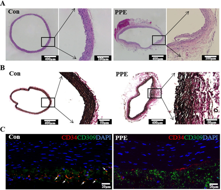 Evaluation of Circulating Endothelial Progenitor Cells in Abdominal Aortic Aneurysms after Endovascular Aneurysm Repair.