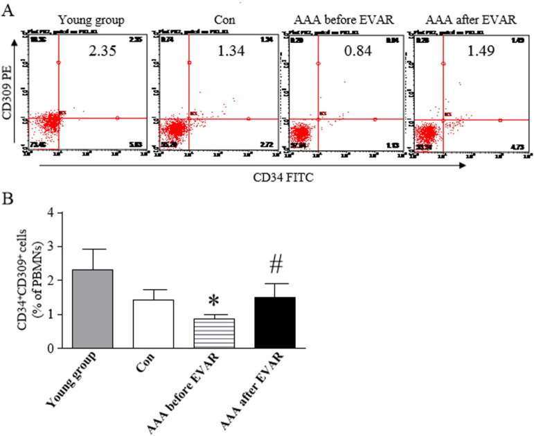 Evaluation of Circulating Endothelial Progenitor Cells in Abdominal Aortic Aneurysms after Endovascular Aneurysm Repair.