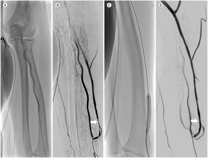 Clinical Efficacy of the Transradial Approach in Percutaneous Intervention for a Malfunctioning Arteriovenous Fistula.