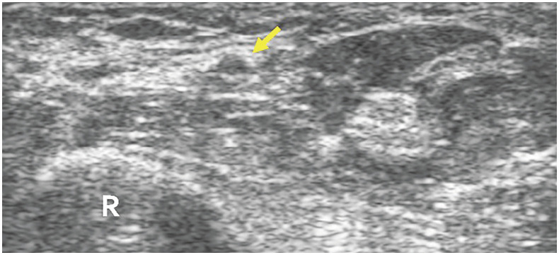 Clinical Efficacy of the Transradial Approach in Percutaneous Intervention for a Malfunctioning Arteriovenous Fistula.