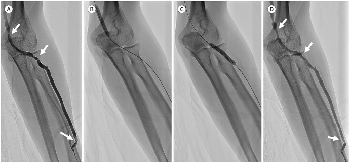 Clinical Efficacy of the Transradial Approach in Percutaneous Intervention for a Malfunctioning Arteriovenous Fistula.