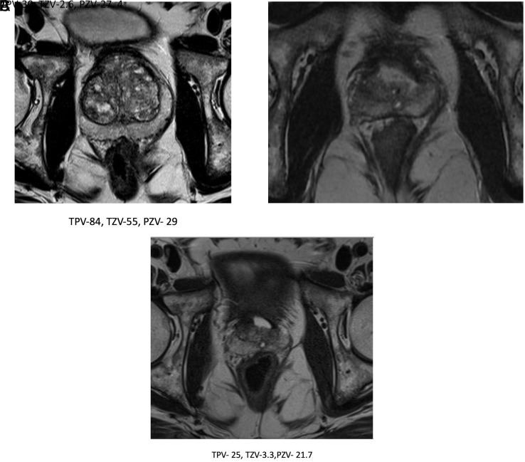 Morphometric Analysis of Prostate Zonal Anatomy After Transurethral Resection of Prostate and Holmium Laser Enucleation of Prostate Using Magnetic Resonance Imaging: A Pilot Study.