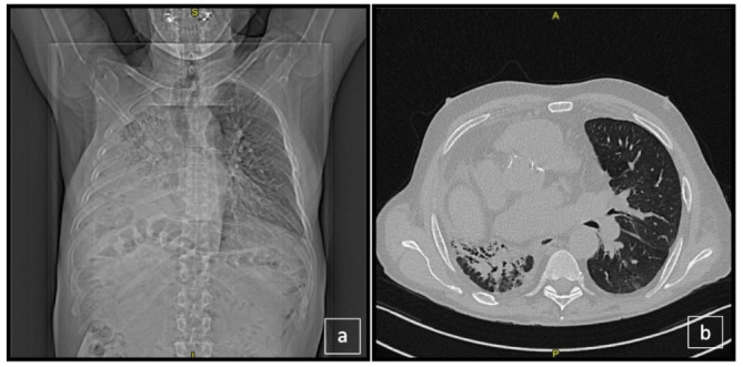 Combined spinal-epidural anesthesia for renal transplant in a lung transplant recipient: a case report.