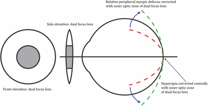 The effect of peripheral defocus on axial growth and modulation of refractive error in hyperopes.