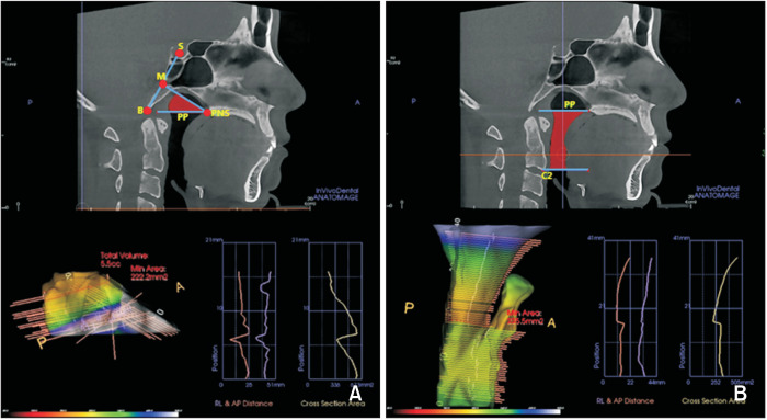 Assessment of pharyngeal airway in Korean adolescents according to skeletal pattern, sex, and cervical vertebral maturation: A cross-sectional CBCT study.