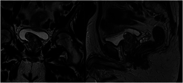 Comprehensive Review on Current Controversies and Debate in Prostate Artery Embolization.