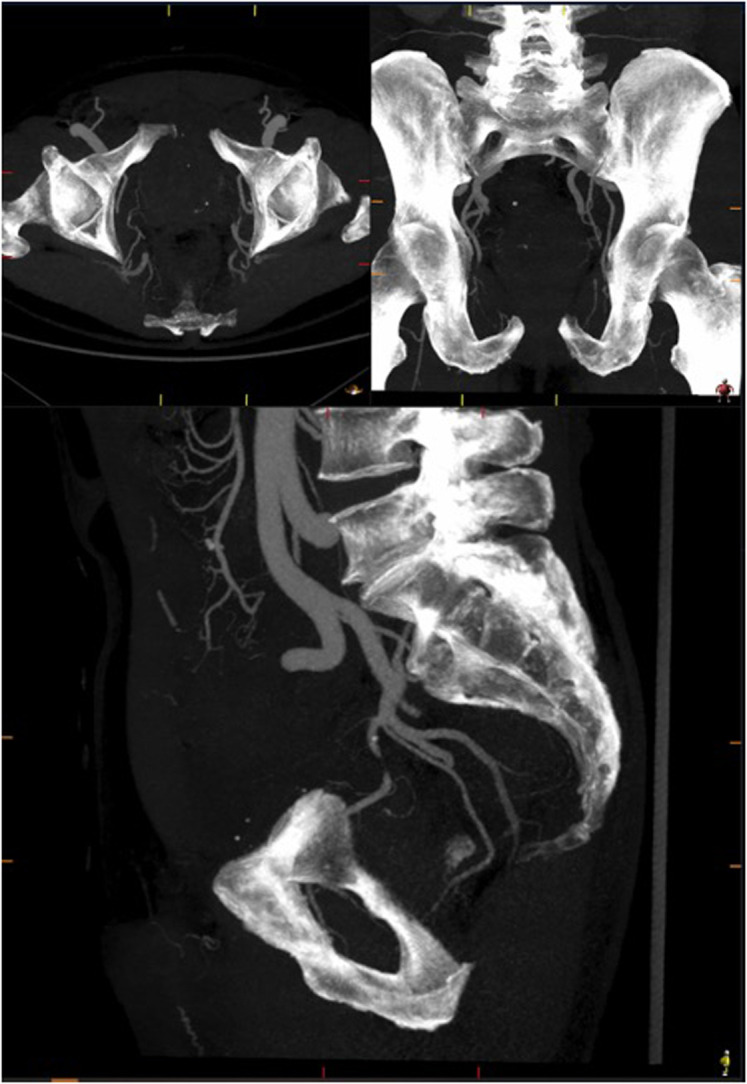 Comprehensive Review on Current Controversies and Debate in Prostate Artery Embolization.