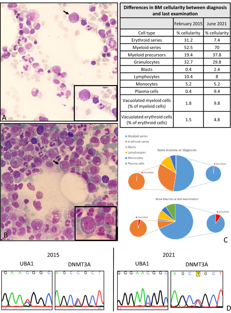 Clinical, Morphological and Clonal Progression of VEXAS Syndrome in the Context of Myelodysplasia Treated with Azacytidine.