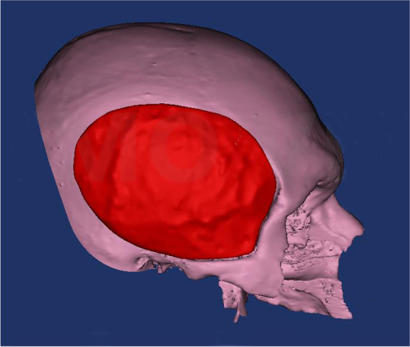 Patient-specific PEEK implants for immediate restoration of temporal fossa after maxillary reconstruction with temporalis muscle flap.