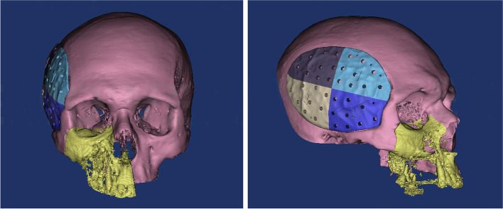 Patient-specific PEEK implants for immediate restoration of temporal fossa after maxillary reconstruction with temporalis muscle flap.