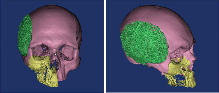 Patient-specific PEEK implants for immediate restoration of temporal fossa after maxillary reconstruction with temporalis muscle flap.