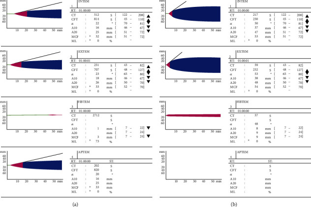 Rotational Thromboelastometry-Guided Venoarterial Extracorporeal Membrane Oxygenation in the Treatment of Amniotic Fluid Embolism.