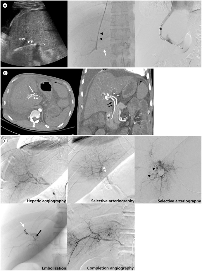 Arterio-Biliary Fistula as a Rare Life-Threatening Complication of Transjugular Intrahepatic Portosystemic Shunt: A Case Report.