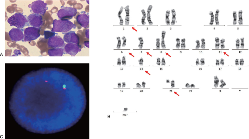 Treatment of STAT5b-RARA positive acute promyelocytic leukemia by Venetoclax combining with homoharringtonine, cytarabine: A case report and literature review.