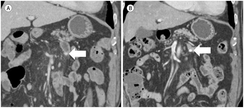 Clinical Course of Small Subepithelial Tumors of the Small Bowel Detected on CT.