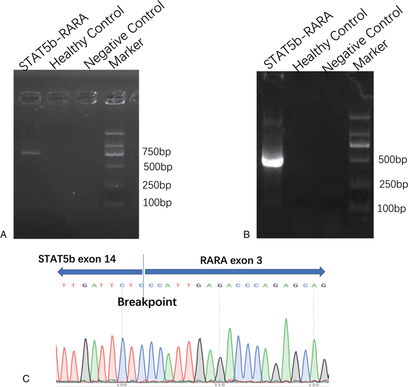 Treatment of STAT5b-RARA positive acute promyelocytic leukemia by Venetoclax combining with homoharringtonine, cytarabine: A case report and literature review.