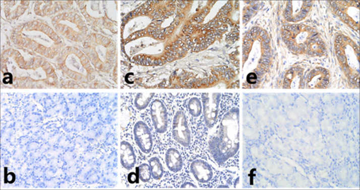 Prognosis of gastric adenocarcinoma associated with girdin, Akt, and cortactin.