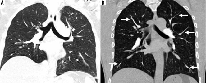 Comparison of high-pitch prospective electrocardiogram-gated pulmonary CT angiography with standard CT pulmonary angiography on dual-source CT for detection of subsegmental pulmonary embolism in patients suspected of acute pulmonary embolism.