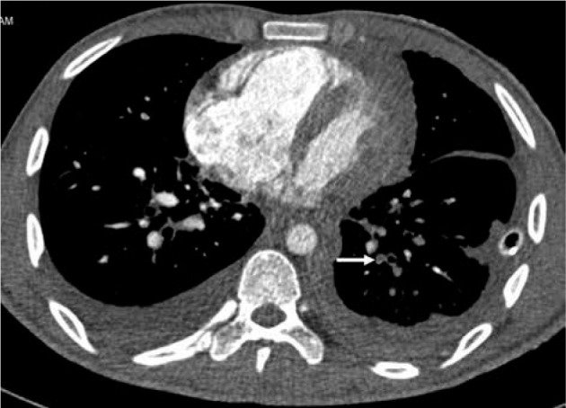 Comparison of high-pitch prospective electrocardiogram-gated pulmonary CT angiography with standard CT pulmonary angiography on dual-source CT for detection of subsegmental pulmonary embolism in patients suspected of acute pulmonary embolism.