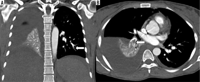 Comparison of high-pitch prospective electrocardiogram-gated pulmonary CT angiography with standard CT pulmonary angiography on dual-source CT for detection of subsegmental pulmonary embolism in patients suspected of acute pulmonary embolism.