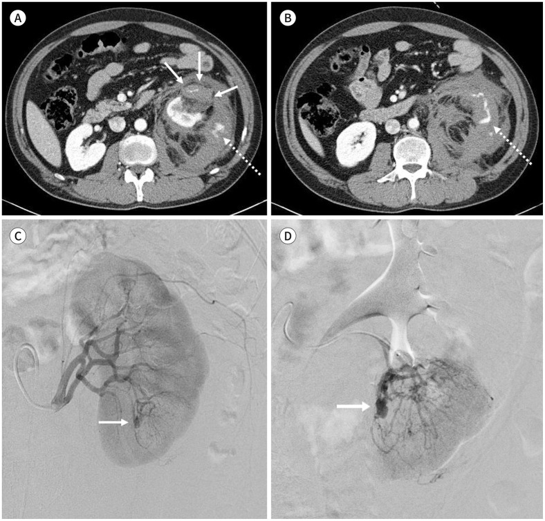 Transarterial Embolization for Sporadic Renal Angiomyolipoma: Patient Selection and Technical Considerations for Optimal Therapeutic Outcomes.