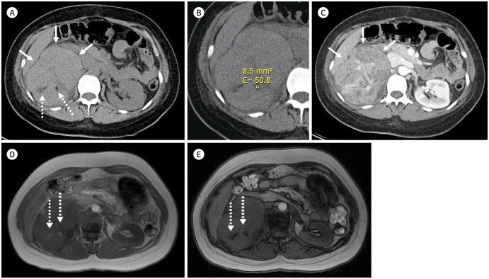 Transarterial Embolization for Sporadic Renal Angiomyolipoma: Patient Selection and Technical Considerations for Optimal Therapeutic Outcomes.