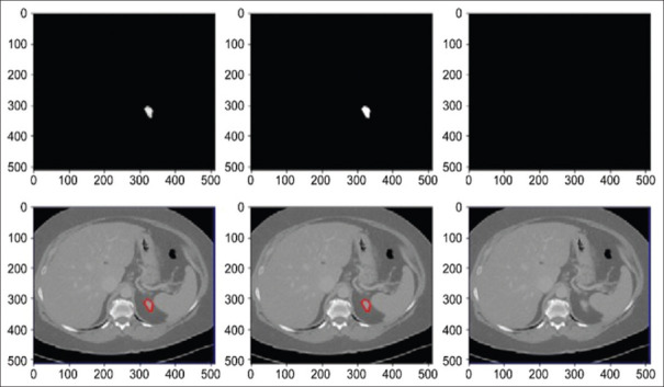 Weight Pruning-UNet: Weight Pruning UNet with Depth-wise Separable Convolutions for Semantic Segmentation of Kidney Tumors.