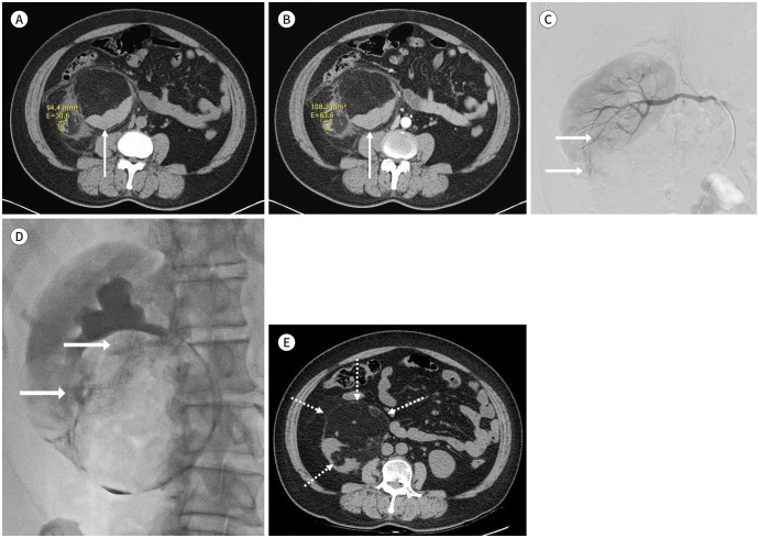 Transarterial Embolization for Sporadic Renal Angiomyolipoma: Patient Selection and Technical Considerations for Optimal Therapeutic Outcomes.