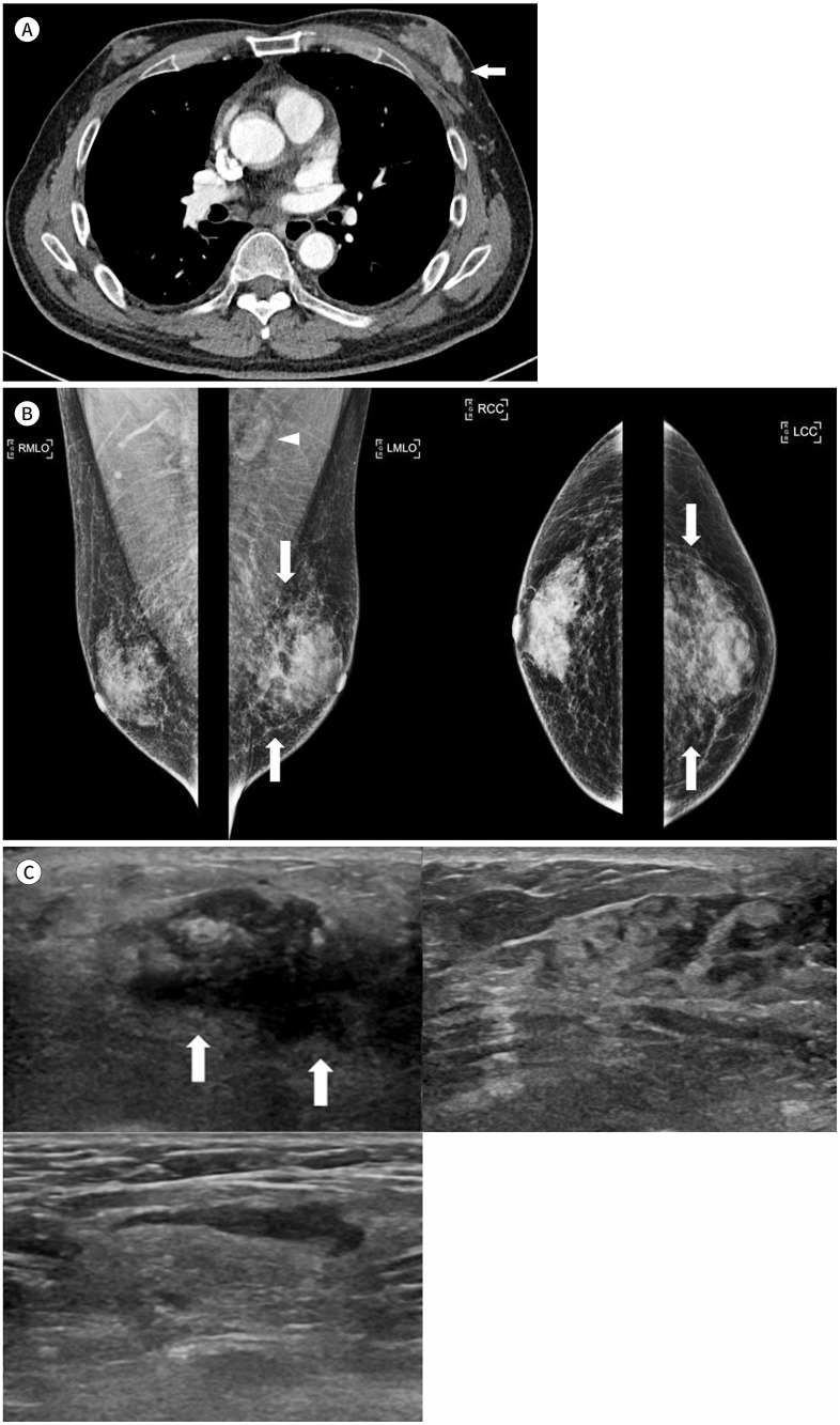 Bladder Cancer Metastasis to the Breast in a Male Patient: Imaging Findings on Mammography and Ultrasonography.