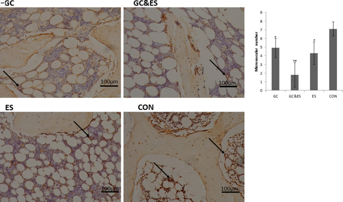 The effect of endostatin on angiogenesis and osteogenesis of steroid-induced osteonecrosis of the femoral head in a rabbit model.