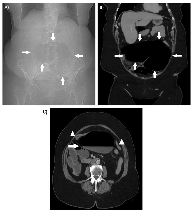 Cecal Volvulus.