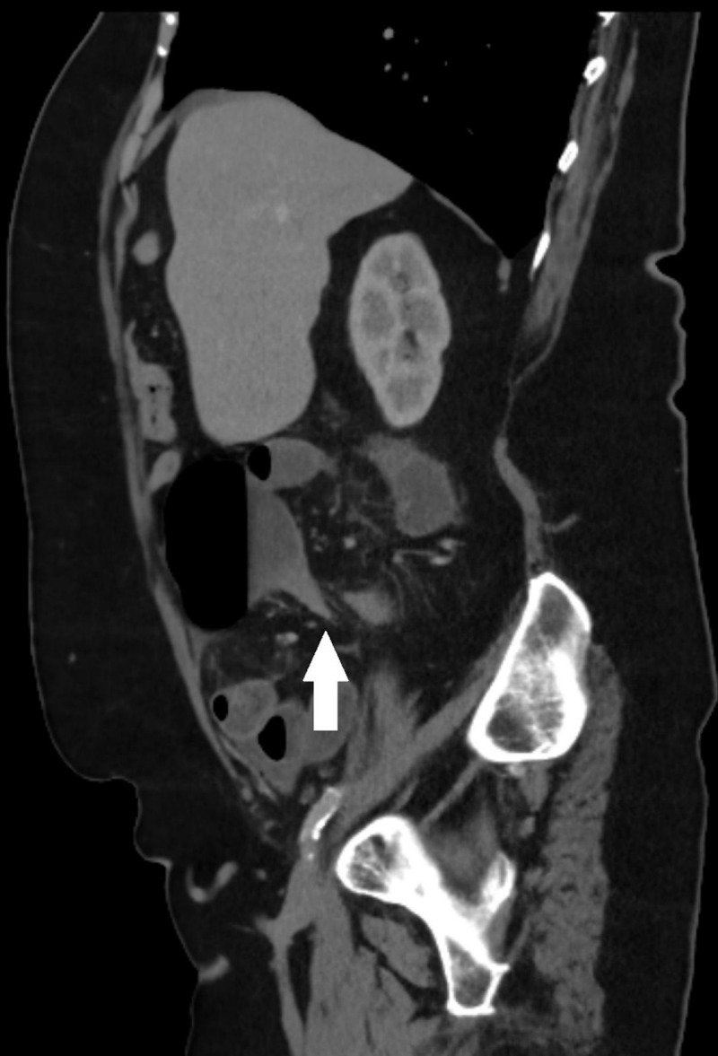 Cecal Volvulus.