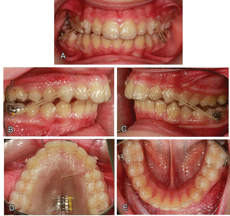 Comparison of skeletal and dentoalveolar effects of two different mandibular advancement methods: conventional technique vs aesthetic approach.