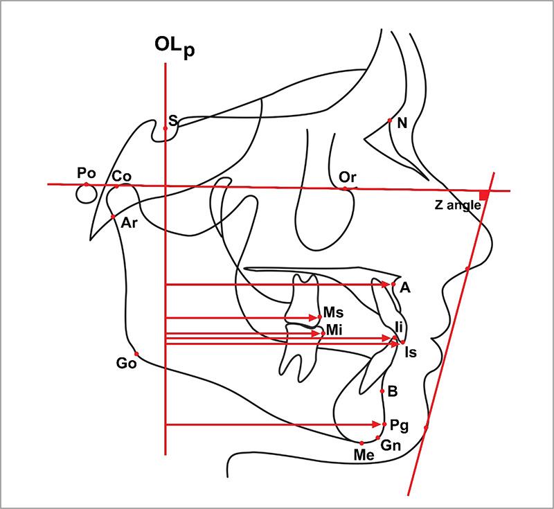 Comparison of skeletal and dentoalveolar effects of two different mandibular advancement methods: conventional technique vs aesthetic approach.