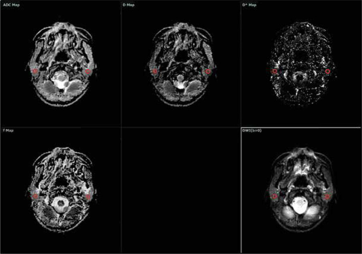 Intravoxel incoherent motion diffusion-weighted imaging (IVIM-DWI) of the major salivary glands: an assessment of the optimal number and combination of <i>b</i>-values.