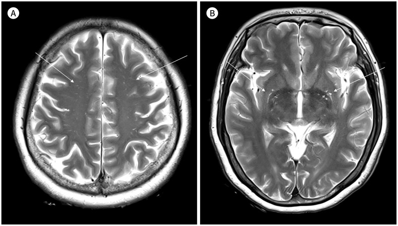 [An Enlarged Perivascular Space: Clinical Relevance and the Role of Imaging in Aging and Neurologic Disorders].