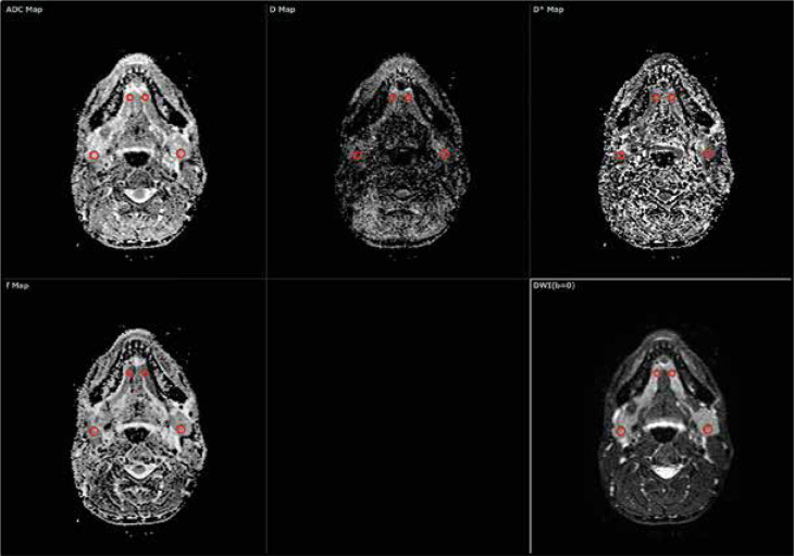 Intravoxel incoherent motion diffusion-weighted imaging (IVIM-DWI) of the major salivary glands: an assessment of the optimal number and combination of <i>b</i>-values.