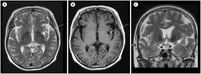 [An Enlarged Perivascular Space: Clinical Relevance and the Role of Imaging in Aging and Neurologic Disorders].